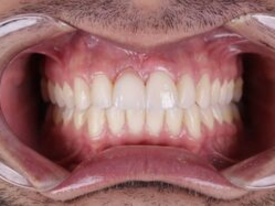Smile Transformations Case 7 - After