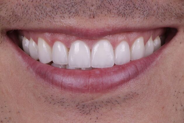 Smile Transformations: Case 3 - After