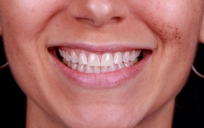 Smile Transformations: Case 4 - Before
