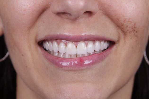Smile Transformations: Case 4 - After