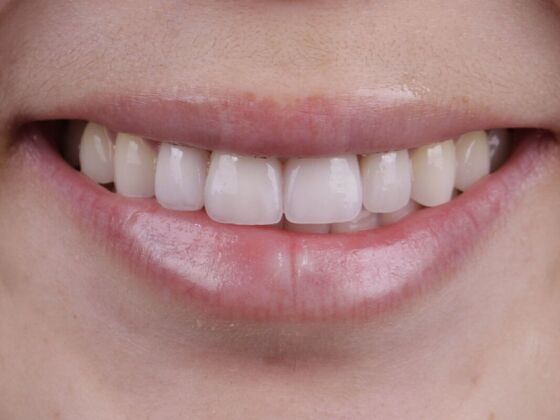 Smile Transformations: Case 6 - After