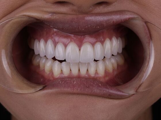 Smile Transformations: Case 5 - After