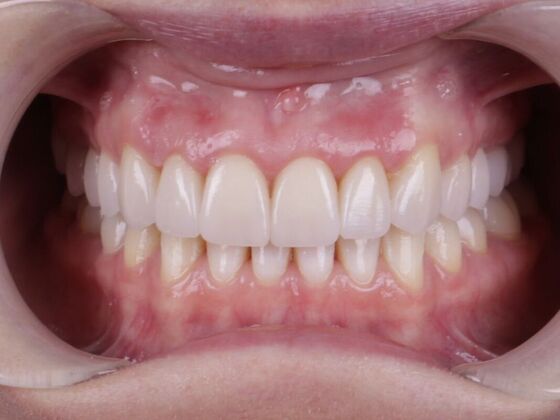 Smile Transformations: Case 2 - After