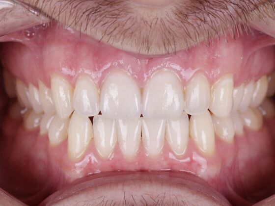 Smile Transformations: Case 1 - After