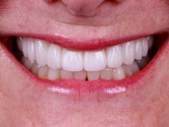 Smile Transformations: Case 8 - After