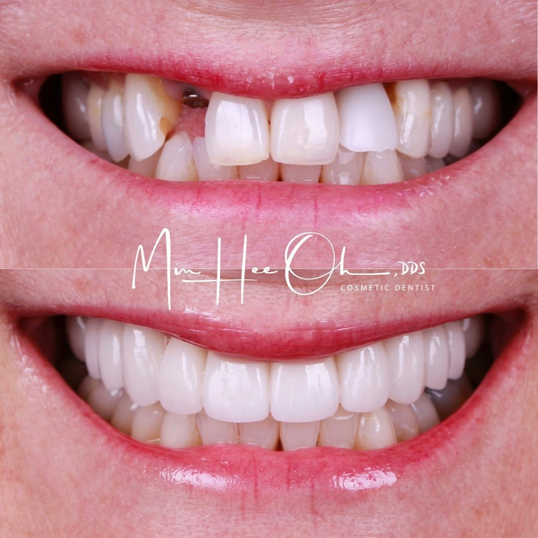 Dr. Oh's patient before and after smile makeover