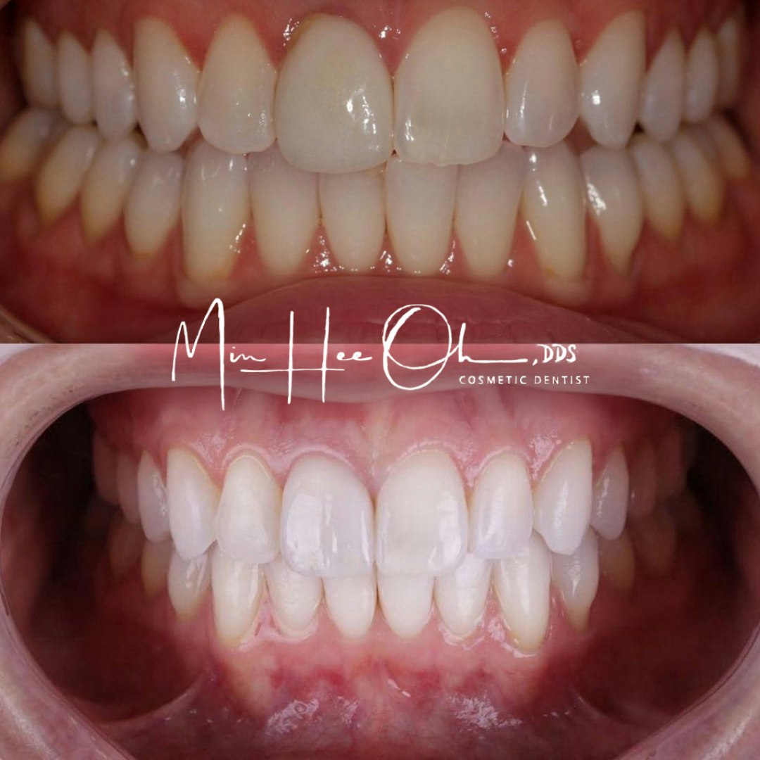 dental crowns before and after